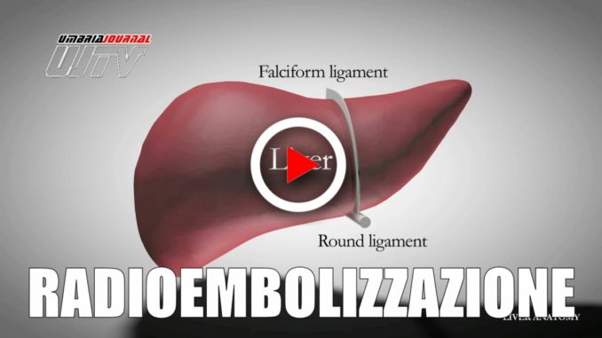 Terapia minivasiva cura tumore fegato avanzato con radioembolizzazione