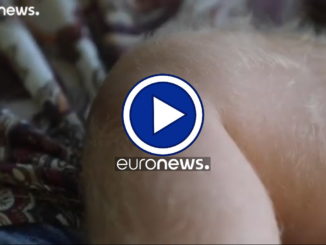 Spagna: bimbi con la "sindrome da lupo mannaro", per scambio di sostanze