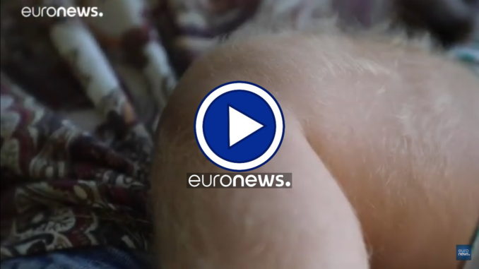 Spagna: bimbi con la "sindrome da lupo mannaro", per scambio di sostanze